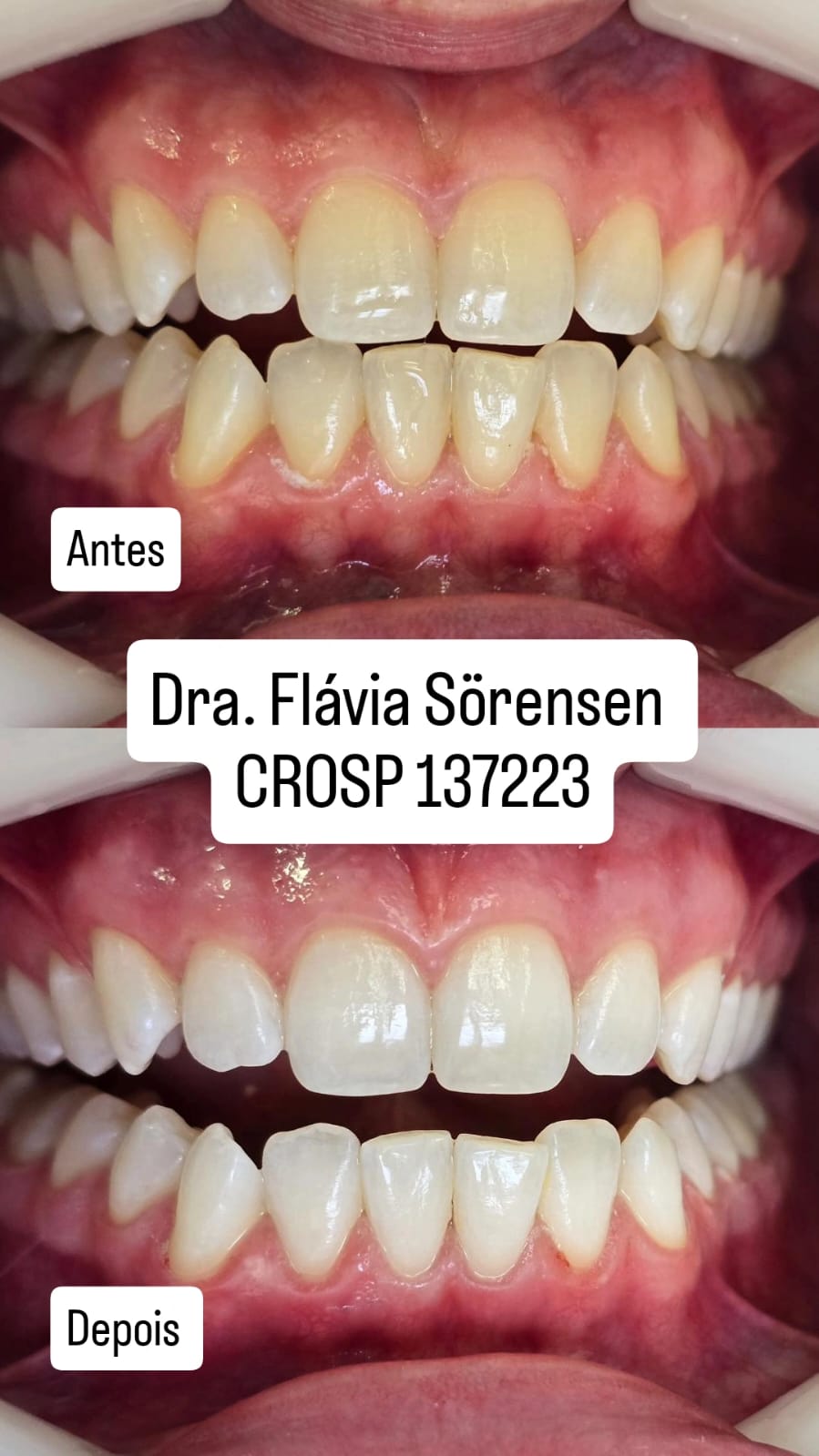 Antes e depois - Transformação do sorriso